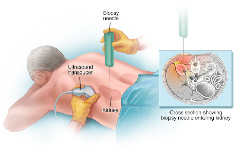 Biopsia Renal Muestra para biopsia renal