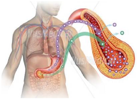 Diabetes millitus Muestra gráfica de diabetes millitus