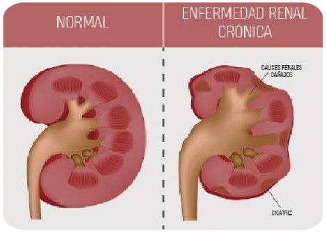 Riñones normal y crónico Riñones normales y con la enfermedad renal crónica