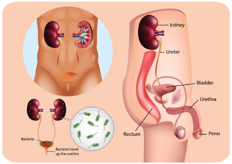 Riñones con bateria Riñones enfermos por bacterias