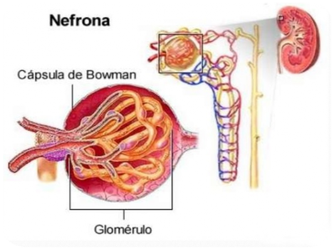 Síndrome Nefrítico Gráfica del síndrome nefrítico