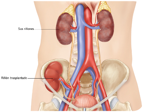 Transplante Renal Método del trasplante renal