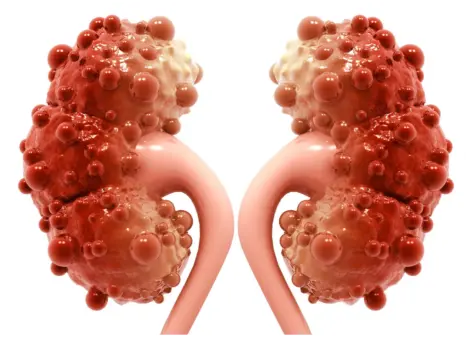 Modo gráfico de los quistes renales