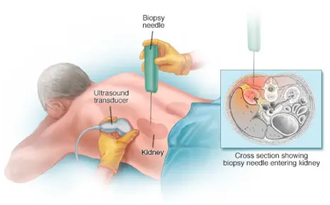 Muestra para biopsia renal