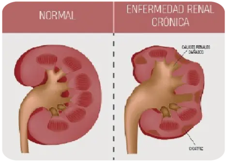 Riñones normales y con la enfermedad renal crónica