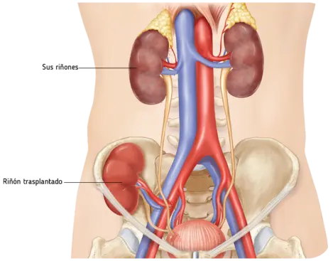 Método del trasplante renal